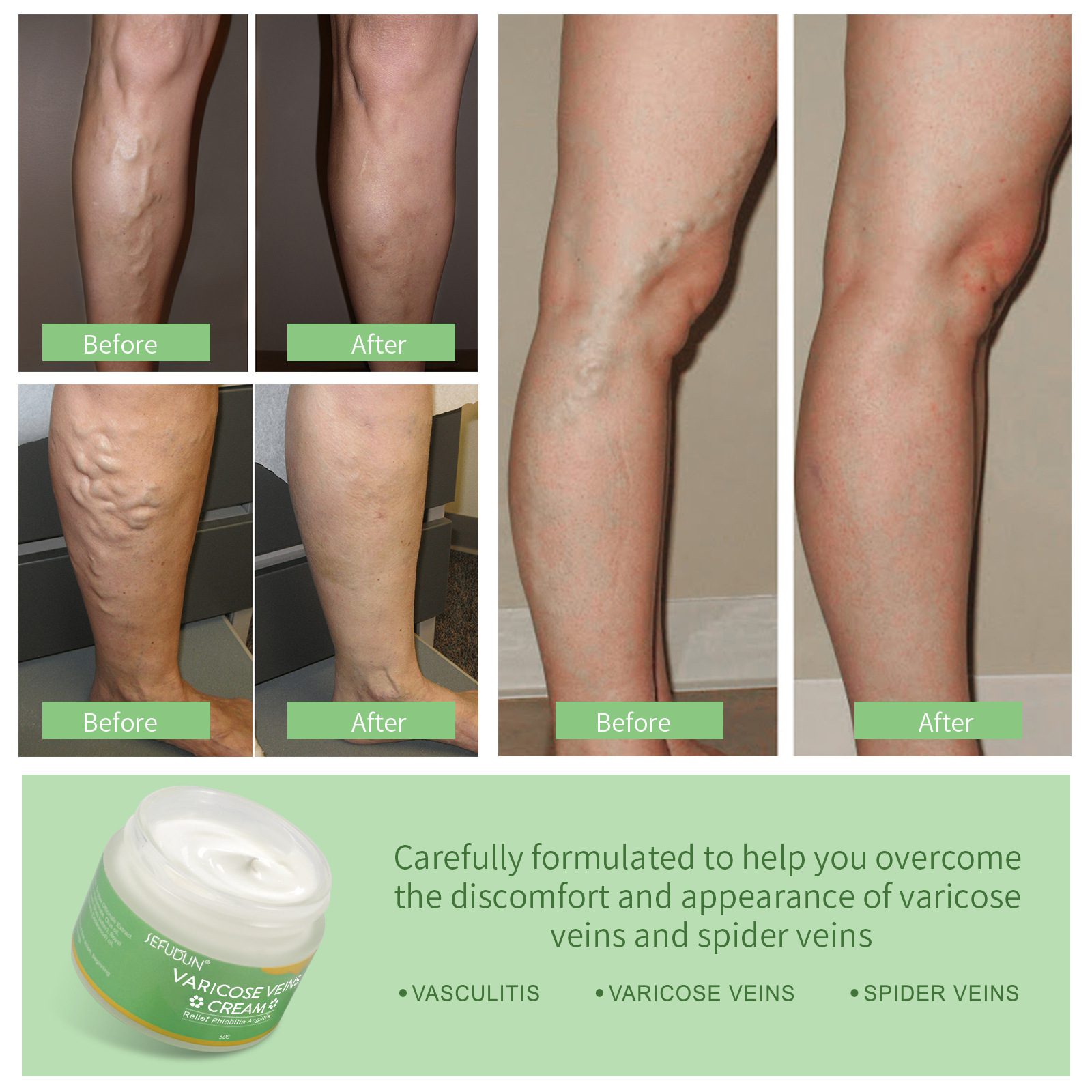 Vein Cream Red Blood Streaks Repair Earthworm Leg Bruises Bulge Relief Pain Safflower Skin care lotion Varicose Cream - Image 5