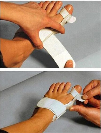 مصحح إبهام القدم الأروح (Hallux Valgus) مع فاصل لإبهام القدم - الصورة 6